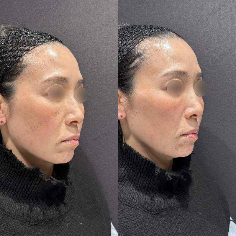 リフトアップ・頬ヒアルロン酸ボリューマ・ボリフト症例写真