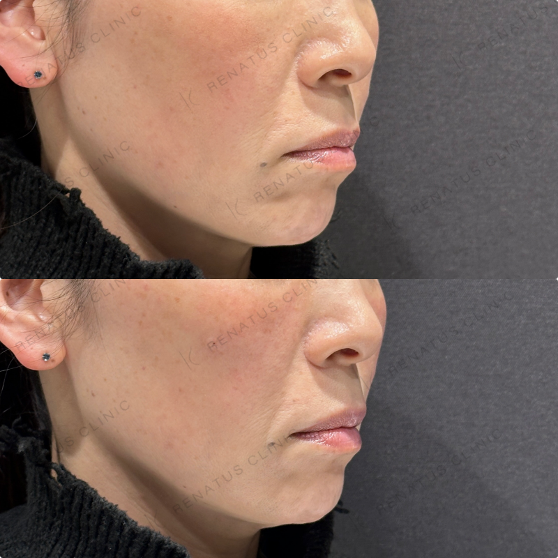 リフトアップ・頬ヒアルロン酸ボリューマ・ボリフト症例写真