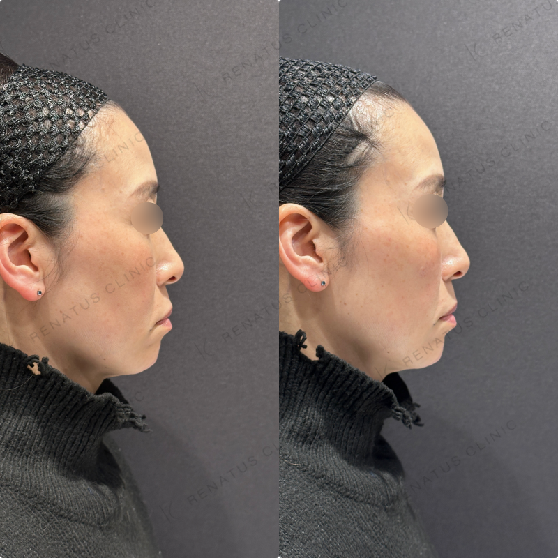 リフトアップ・頬ヒアルロン酸ボリューマ・ボリフト症例写真