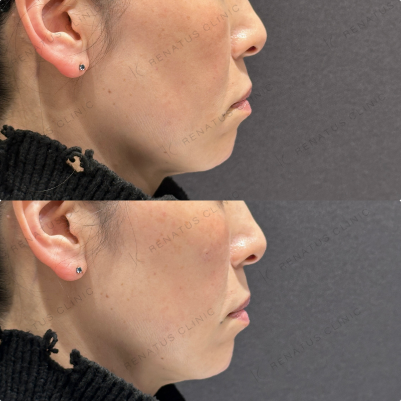 リフトアップ・頬ヒアルロン酸ボリューマ・ボリフト症例写真