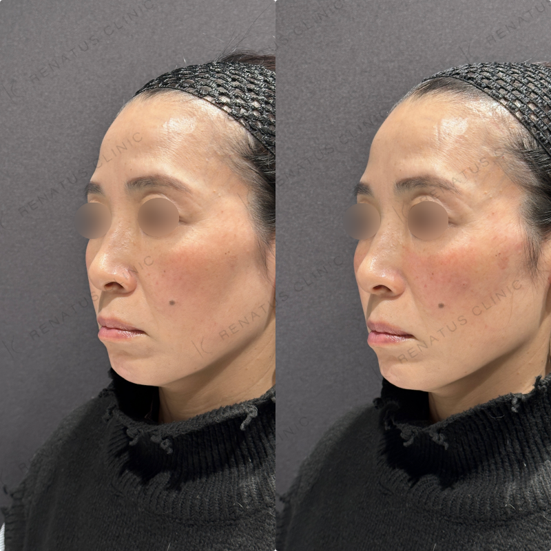 リフトアップ・頬ヒアルロン酸ボリューマ・ボリフト症例写真