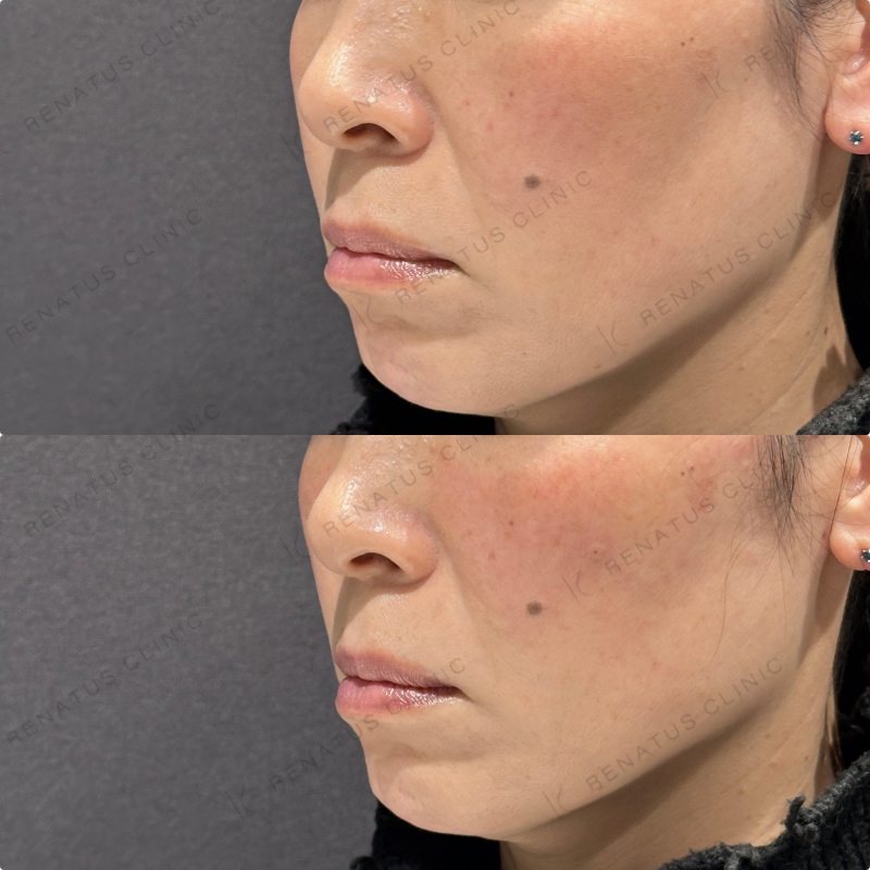 リフトアップ・頬ヒアルロン酸ボリューマ・ボリフト症例写真