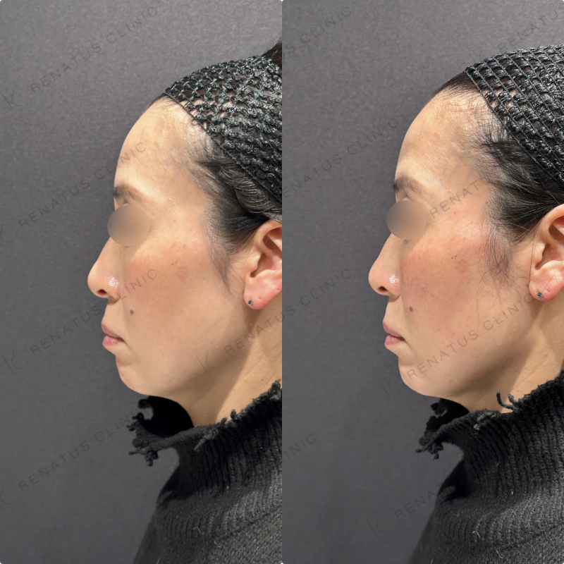 リフトアップ・頬ヒアルロン酸ボリューマ・ボリフト症例写真