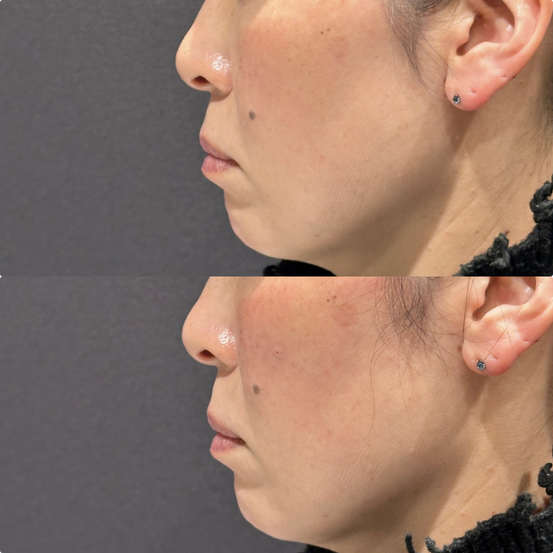 リフトアップ・頬ヒアルロン酸ボリューマ・ボリフト症例写真