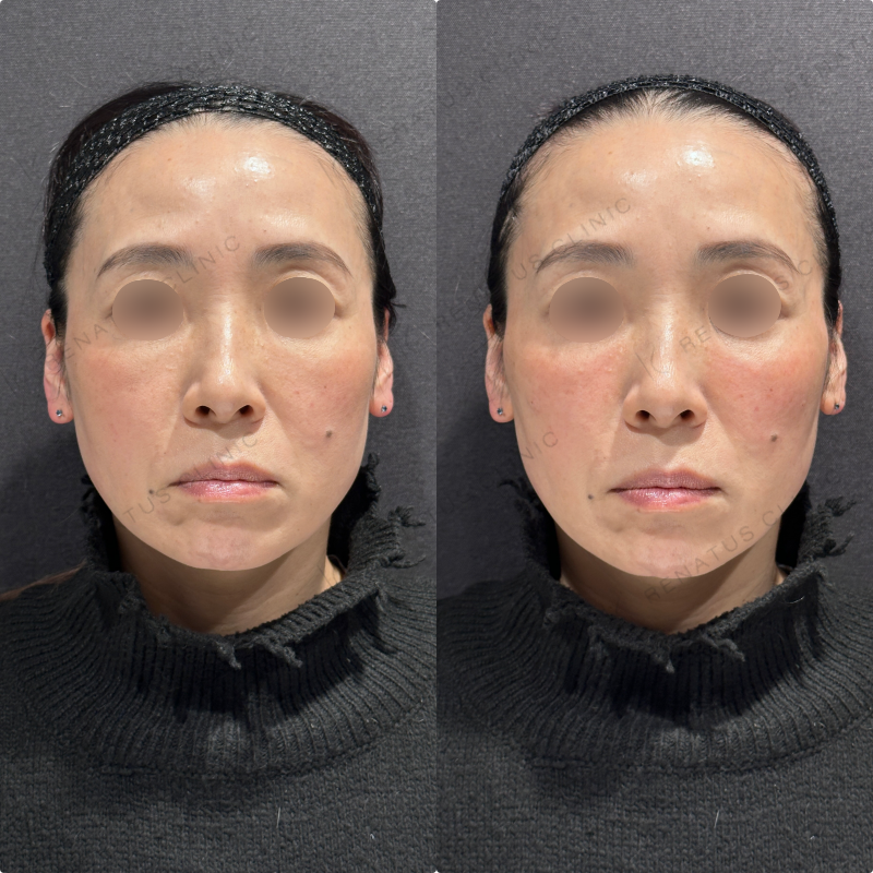 リフトアップ・頬ヒアルロン酸ボリューマ・ボリフト症例写真