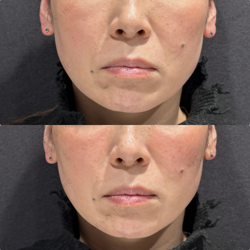 リフトアップ・頬ヒアルロン酸ボリューマ・ボリフト症例写真