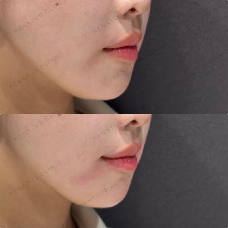 マリオネットラインヒアルロン酸ボリューマ症例写真