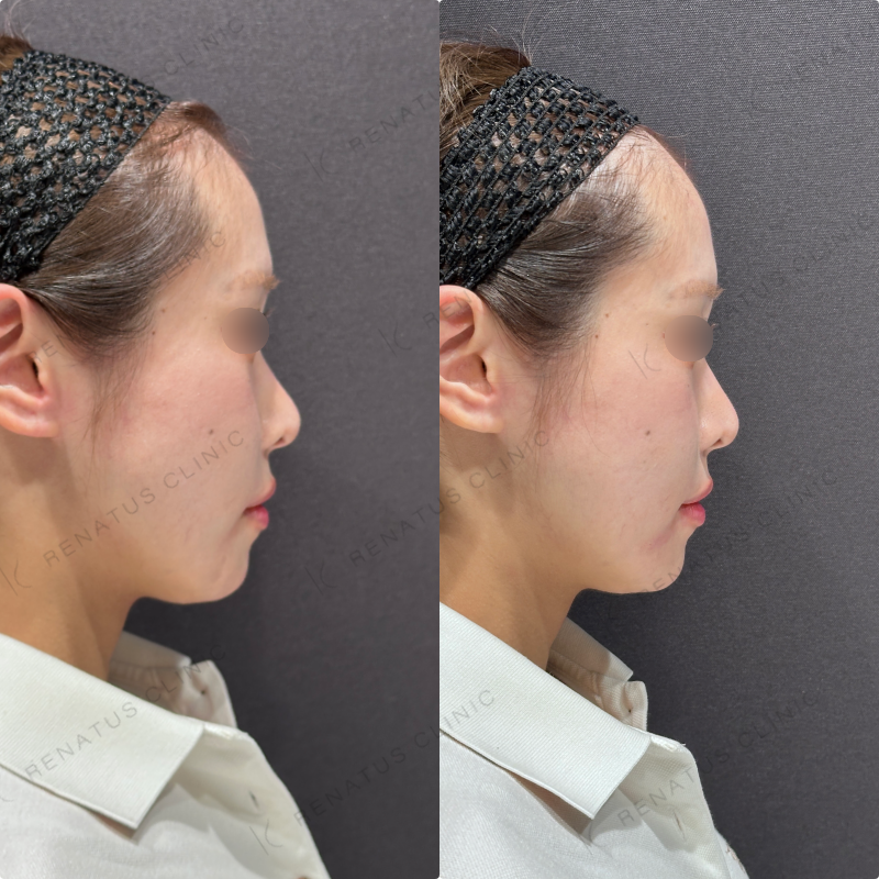 マリオネットラインヒアルロン酸ボリューマ症例写真