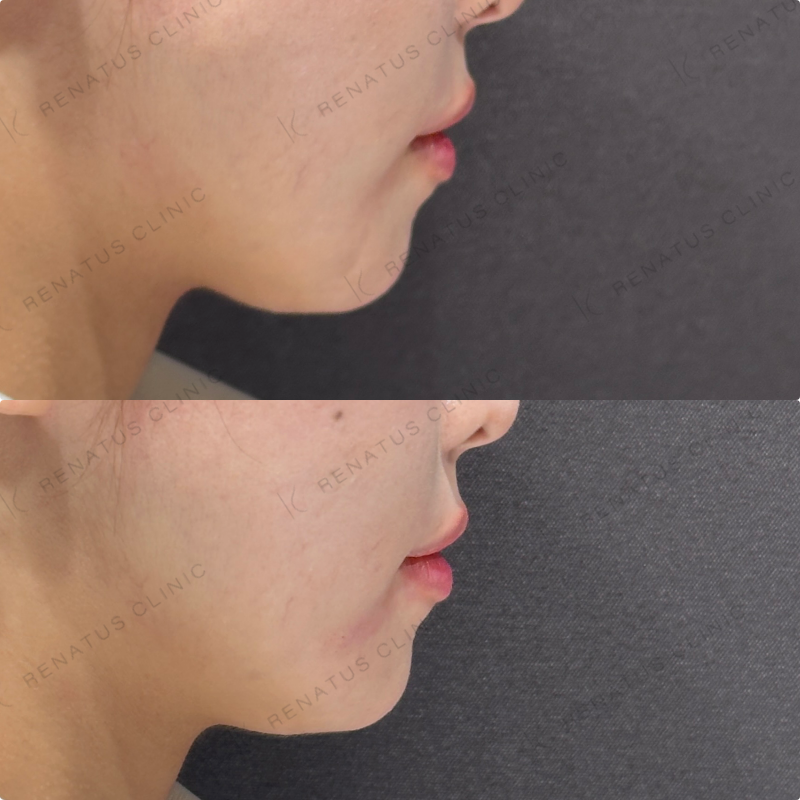 マリオネットラインヒアルロン酸ボリューマ症例写真