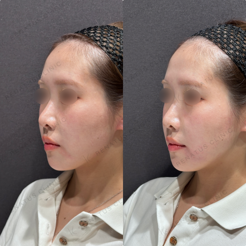 マリオネットラインヒアルロン酸ボリューマ症例写真