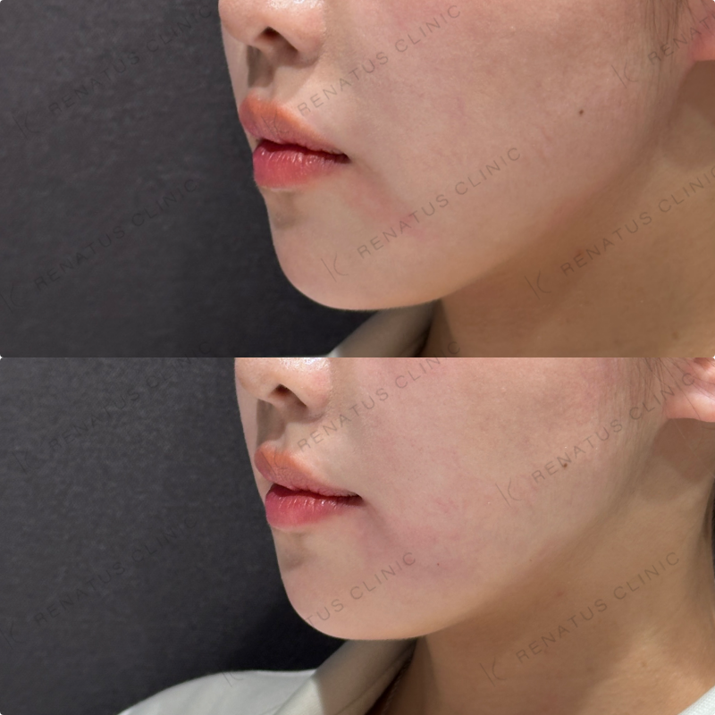 マリオネットラインヒアルロン酸ボリューマ症例写真