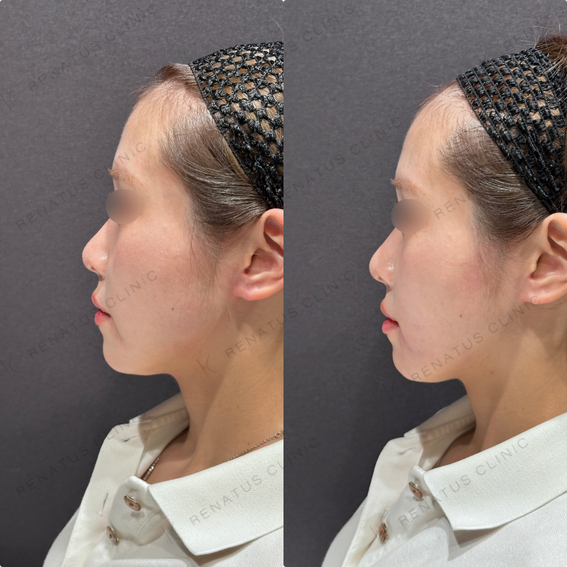 マリオネットラインヒアルロン酸ボリューマ症例写真