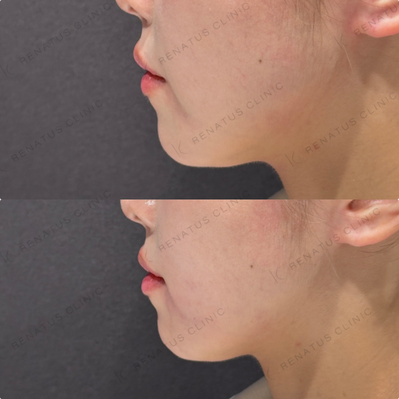 マリオネットラインヒアルロン酸ボリューマ症例写真