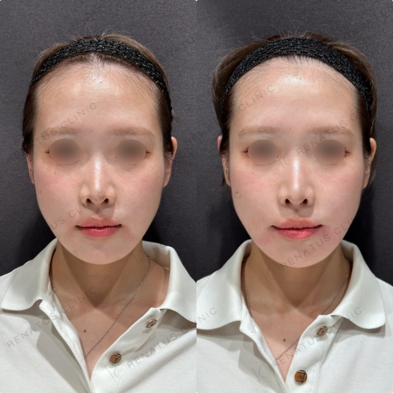 マリオネットラインヒアルロン酸ボリューマ症例写真