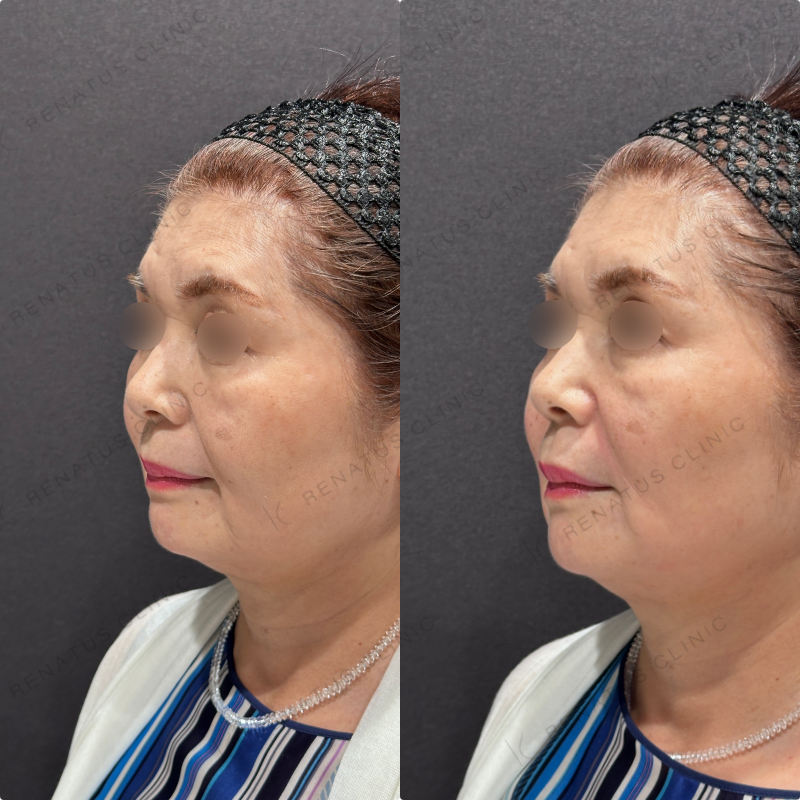 マリオネット・ほうれい線ヒアルロン酸ボリューマ・ボリフト症例写真