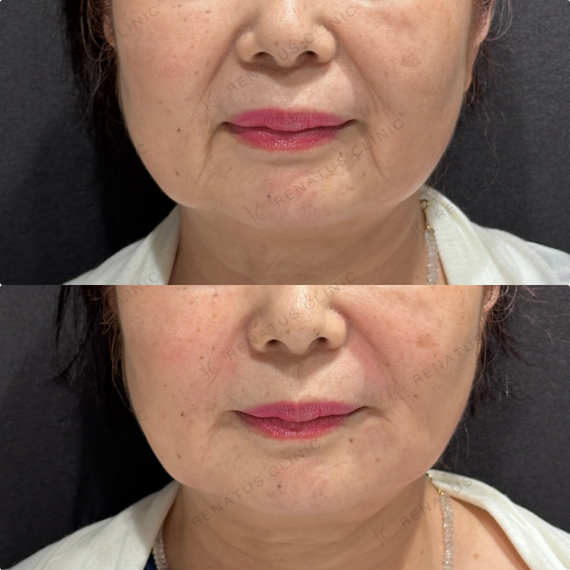 マリオネット・ほうれい線ヒアルロン酸ボリューマ・ボリフト症例写真