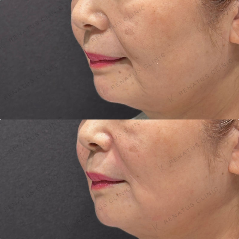 マリオネット・ほうれい線ヒアルロン酸ボリューマ・ボリフト症例写真