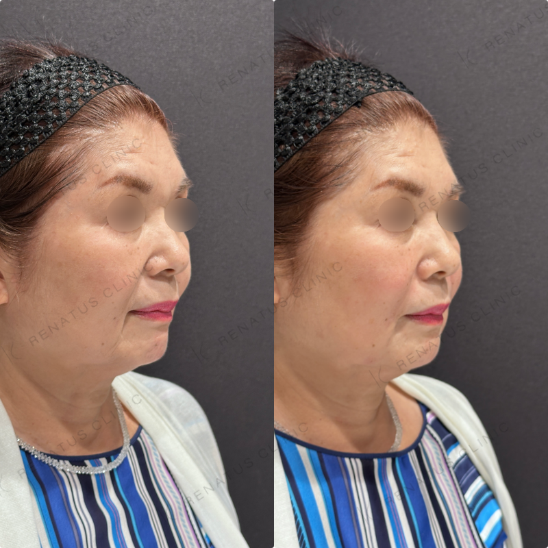 マリオネット・ほうれい線ヒアルロン酸ボリューマ・ボリフト症例写真