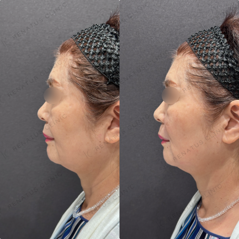 マリオネット・ほうれい線ヒアルロン酸ボリューマ・ボリフト症例写真