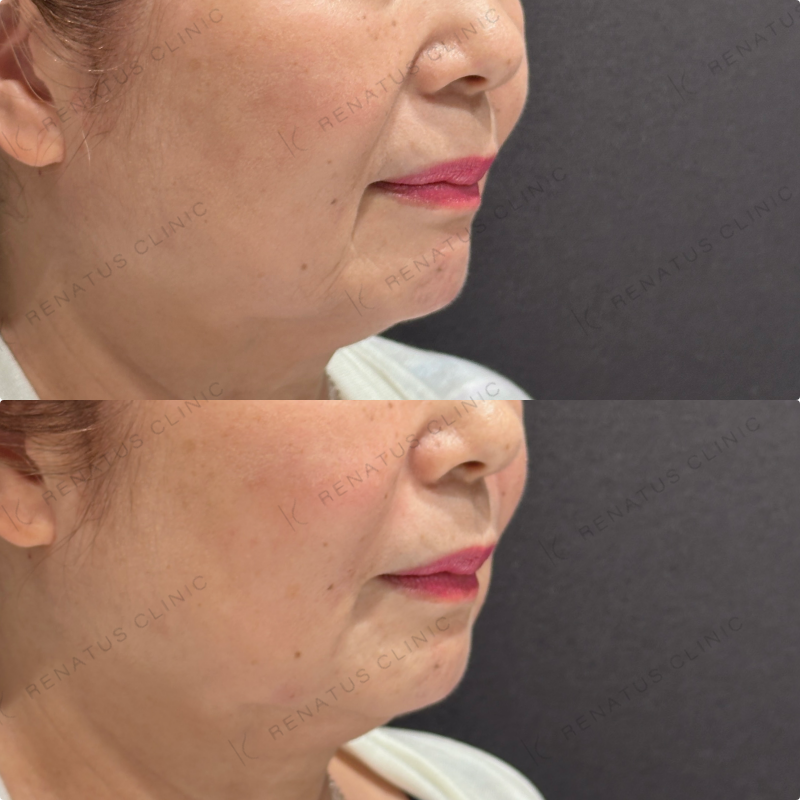 マリオネット・ほうれい線ヒアルロン酸ボリューマ・ボリフト症例写真