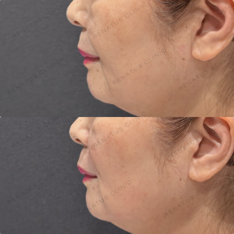 マリオネット・ほうれい線ヒアルロン酸ボリューマ・ボリフト症例写真