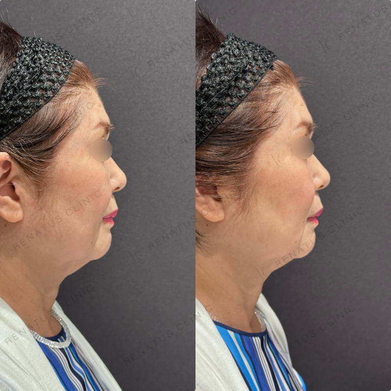 マリオネット・ほうれい線ヒアルロン酸ボリューマ・ボリフト症例写真