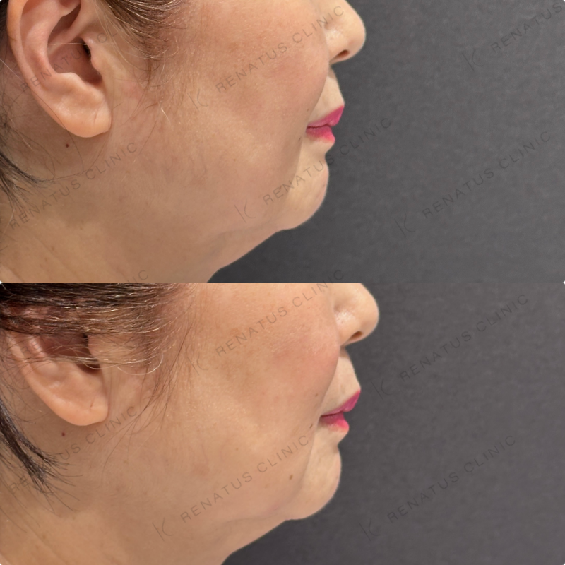 マリオネット・ほうれい線ヒアルロン酸ボリューマ・ボリフト症例写真