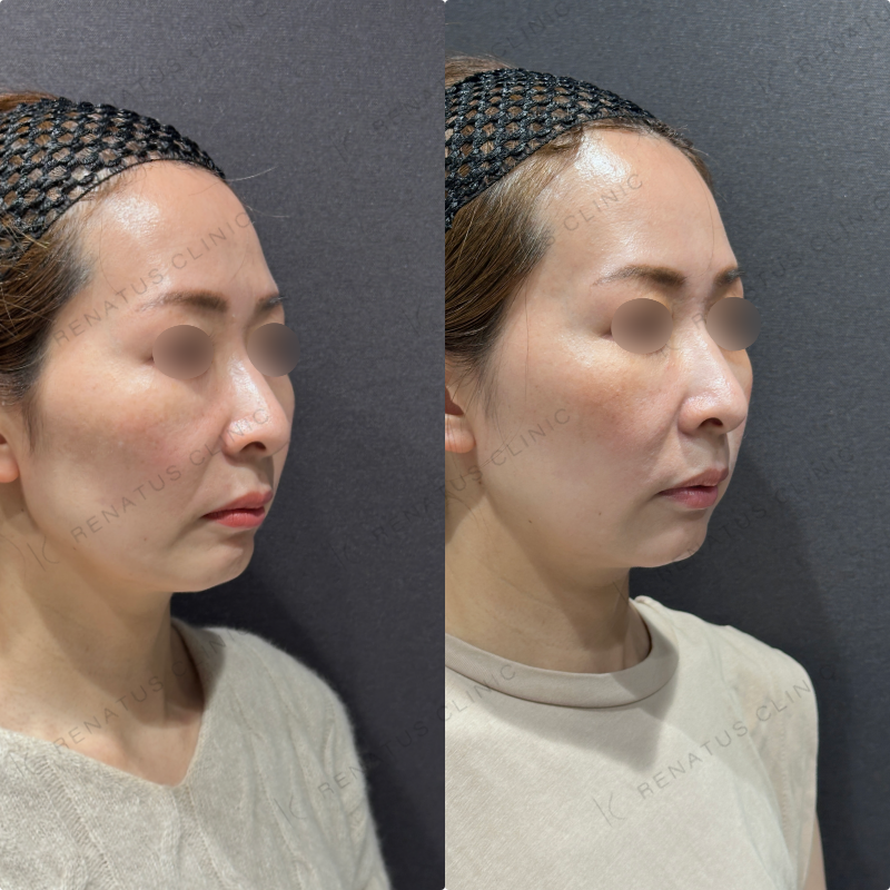 マリオネット・口角横ヒアルロン酸ボリフト・ボライト症例写真