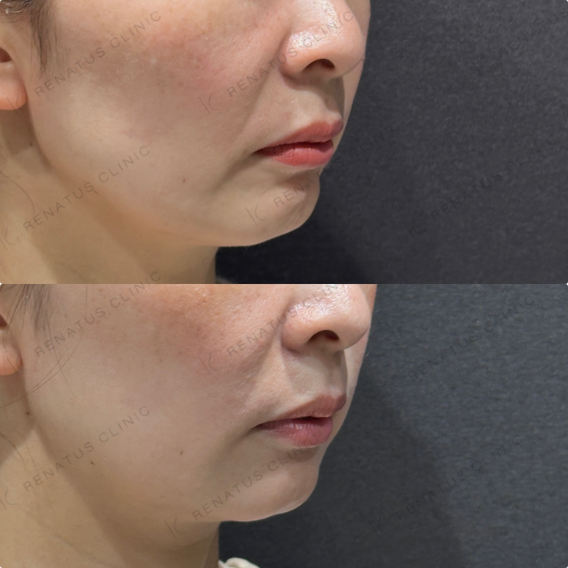 マリオネット・口角横ヒアルロン酸ボリフト・ボライト症例写真