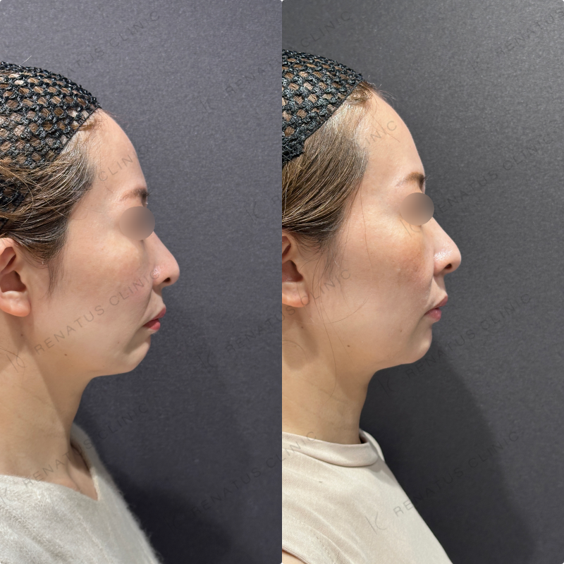 マリオネット・口角横ヒアルロン酸ボリフト・ボライト症例写真