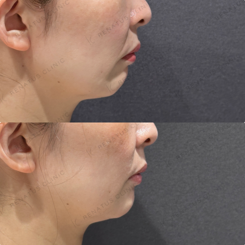 マリオネット・口角横ヒアルロン酸ボリフト・ボライト症例写真