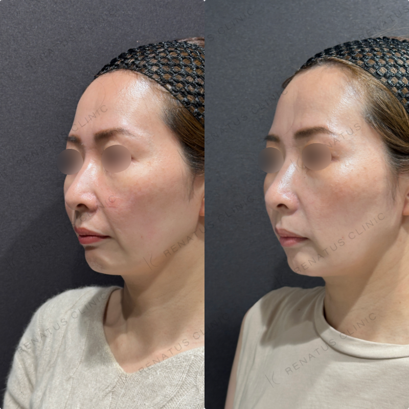 マリオネット・口角横ヒアルロン酸ボリフト・ボライト症例写真