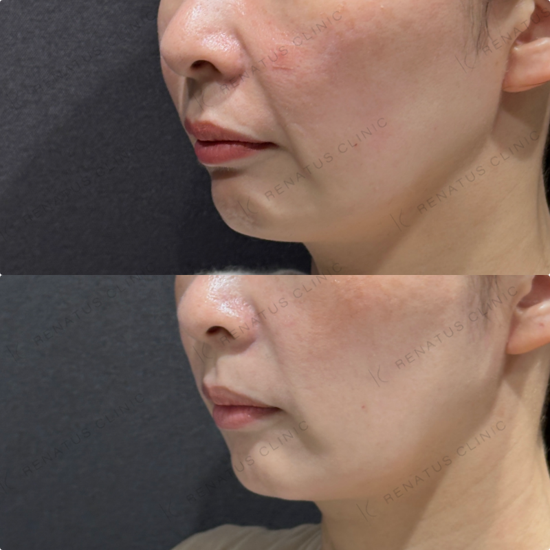 マリオネット・口角横ヒアルロン酸ボリフト・ボライト症例写真