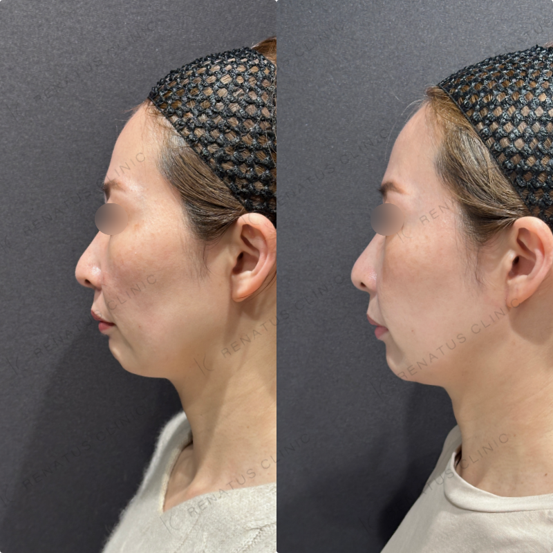 マリオネット・口角横ヒアルロン酸ボリフト・ボライト症例写真