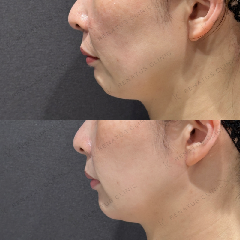 マリオネット・口角横ヒアルロン酸ボリフト・ボライト症例写真