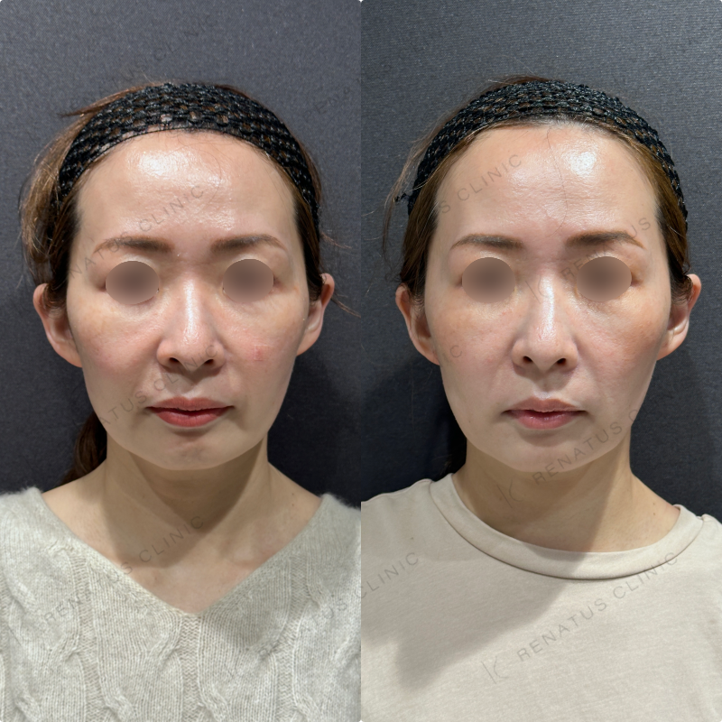 マリオネット・口角横ヒアルロン酸ボリフト・ボライト症例写真