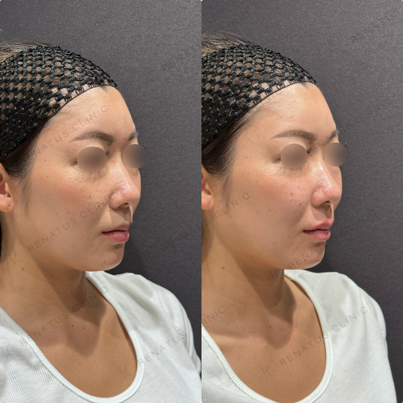 上唇ヒアルロン酸ボルベラ症例写真