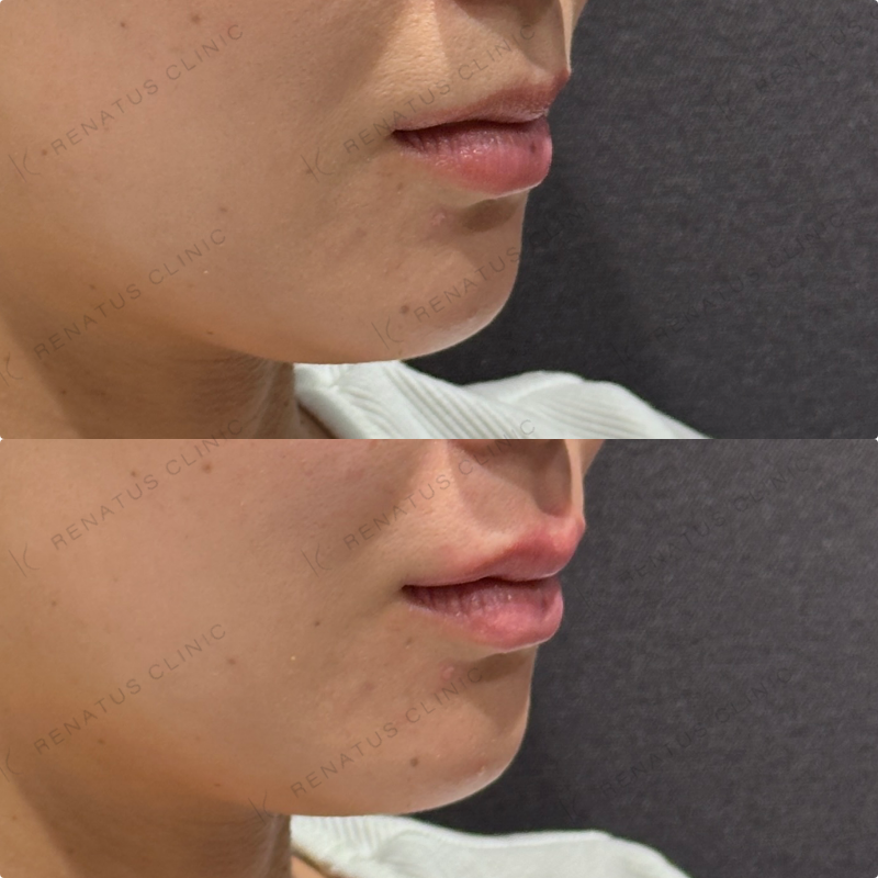 上唇ヒアルロン酸ボルベラ症例写真