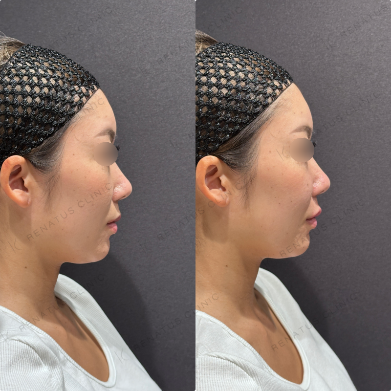 上唇ヒアルロン酸ボルベラ症例写真