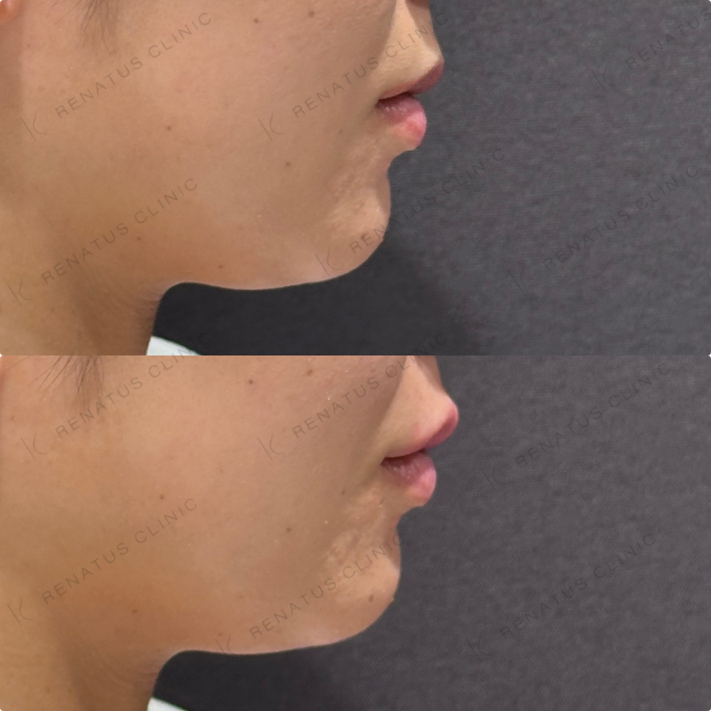 上唇ヒアルロン酸ボルベラ症例写真