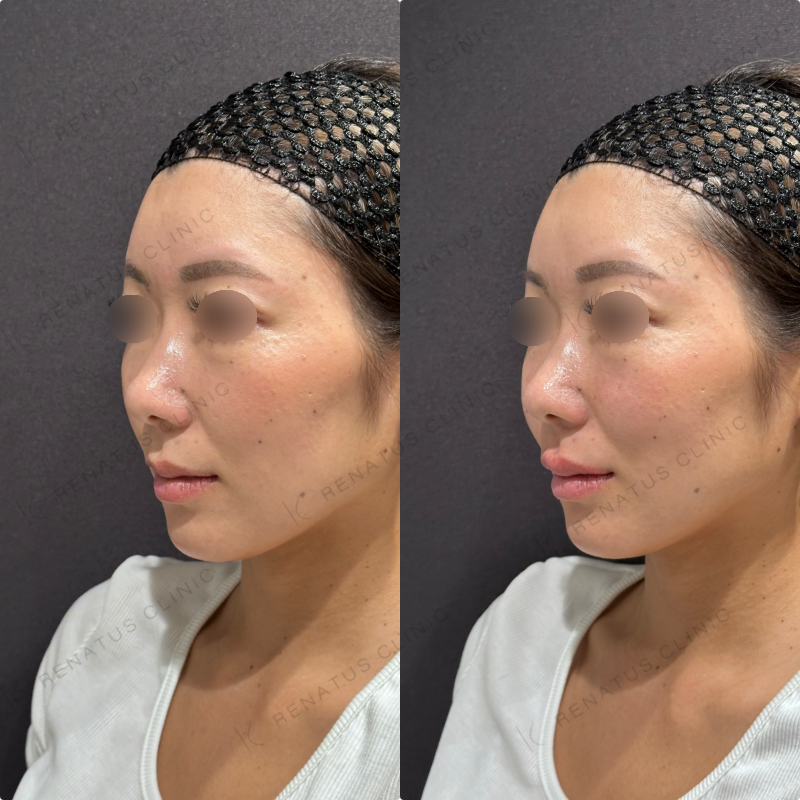 上唇ヒアルロン酸ボルベラ症例写真