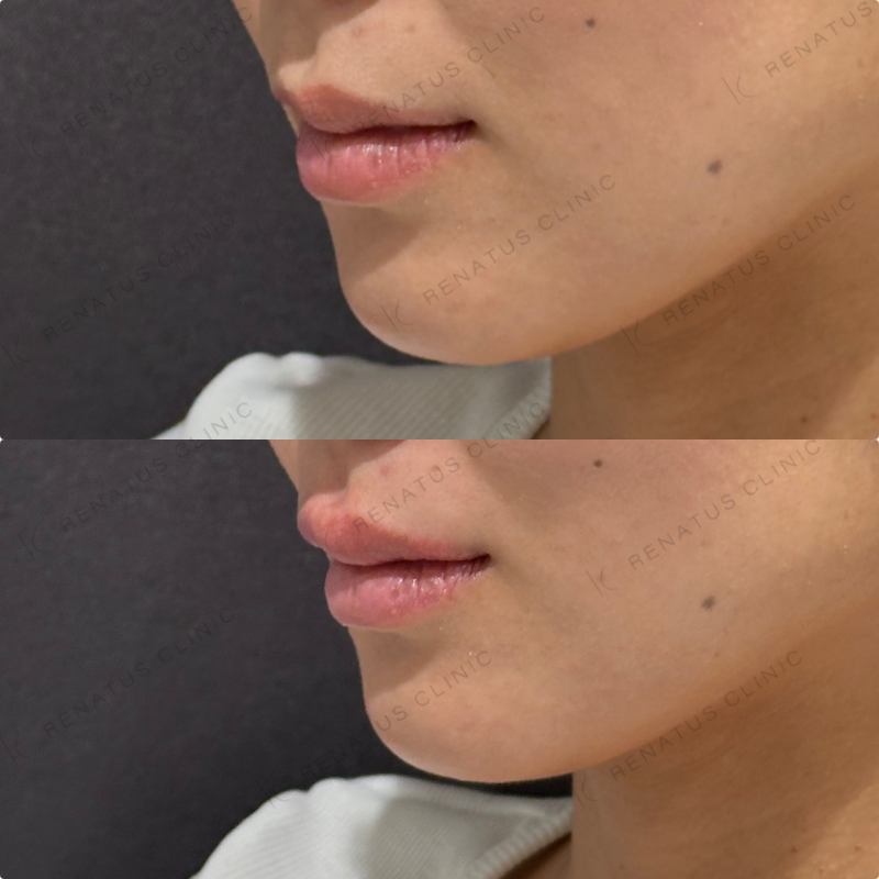 上唇ヒアルロン酸ボルベラ症例写真