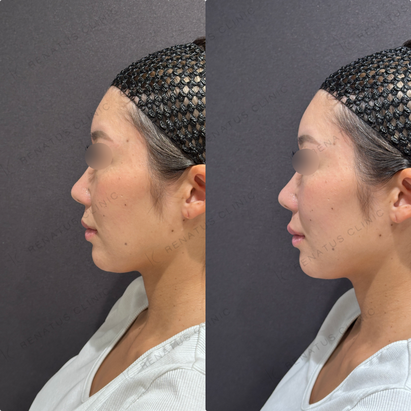 上唇ヒアルロン酸ボルベラ症例写真