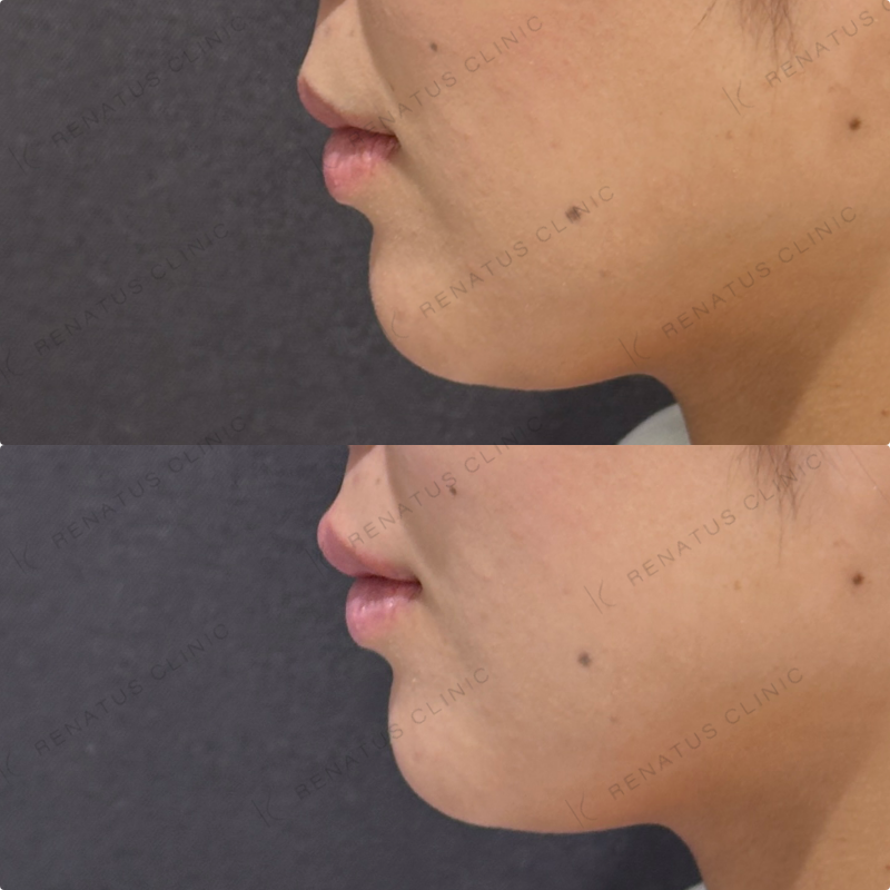 上唇ヒアルロン酸ボルベラ症例写真