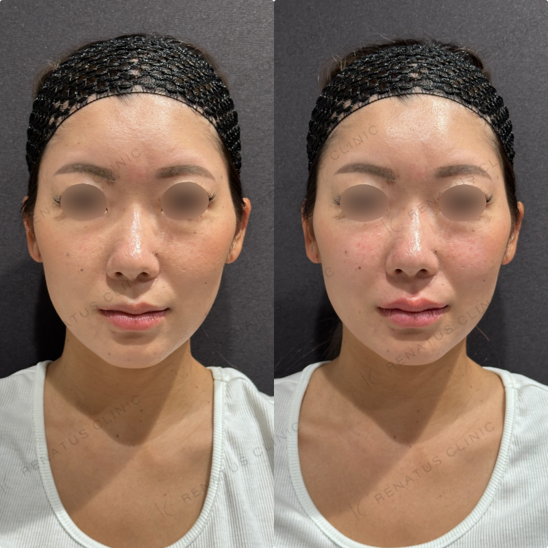 上唇ヒアルロン酸ボルベラ症例写真