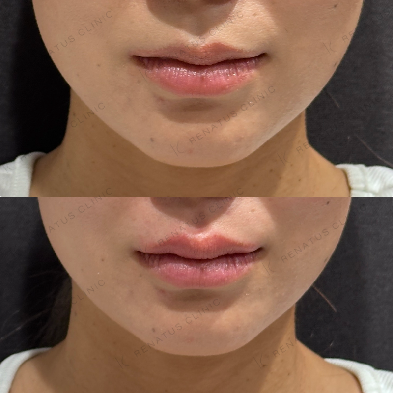 上唇ヒアルロン酸ボルベラ症例写真