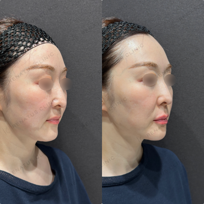 上唇・Cカール・下唇ヒアルロン酸ボルベラ症例写真