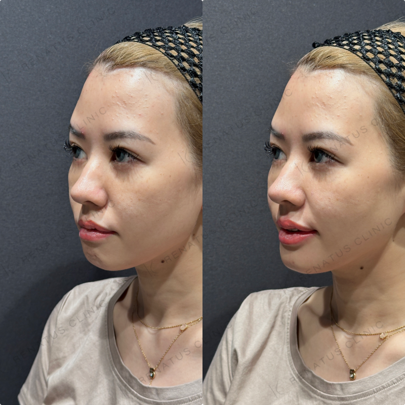 上唇・Cカール・下唇ヒアルロン酸ボルベラ症例写真