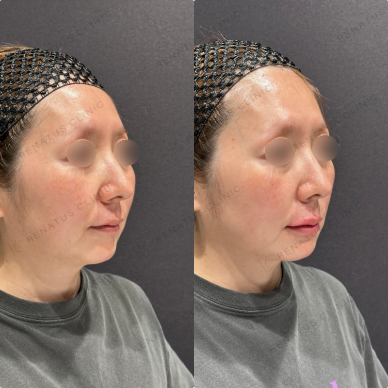 上唇・Cカール・下唇ヒアルロン酸ボルベラ症例写真