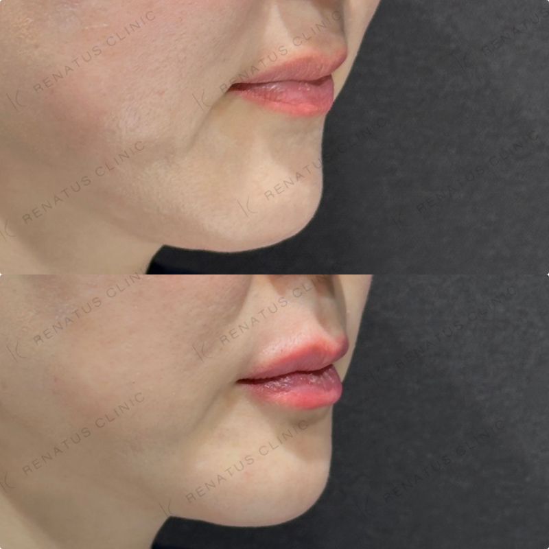 上唇・Cカール・下唇ヒアルロン酸ボルベラ症例写真
